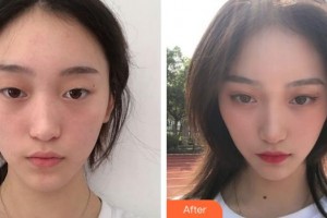 宣城眼科醫(yī)院張解忠整形價(jià)格表附眼部綜合案例展示