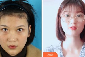 宣城眼科醫(yī)院楊國棟整形價(jià)格表附內(nèi)切祛眼袋案例展示