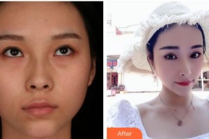 宣城康視五官科醫(yī)院眼科王倫斌整形價(jià)格表附切開雙眼皮案例展示