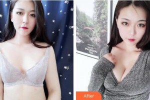 浙江綠城醫(yī)院整形美容中心徐堅(jiān)方整形價(jià)格表附隆胸案例展示