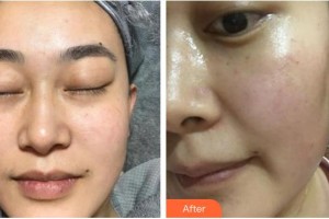 浙江省中醫(yī)院整形美容中心王雅飛整形價(jià)格表附光子嫩膚案例展示