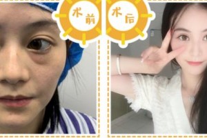 浙江省人民醫(yī)院整形外科冀宇整形價(jià)格表附埋線提升案例展示