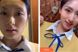 浙江衢化醫(yī)院激光整形美容中心陳玲玲整形價(jià)格表附埋線提升案例展示