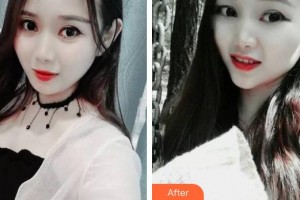 浙江大學(xué)醫(yī)學(xué)院附屬口腔醫(yī)院程志鵬整形價(jià)格表附牙齒隱形矯正案例展示