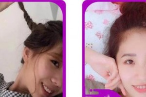 浙江大學(xué)醫(yī)學(xué)院附屬口腔醫(yī)院何福明整形價(jià)格表附牙齒隱形矯正案例展示