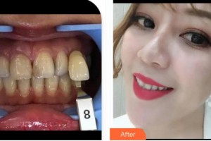 浙江大學(xué)醫(yī)學(xué)院附屬口腔醫(yī)院張凱整形價(jià)格表附冷光美白案例展示