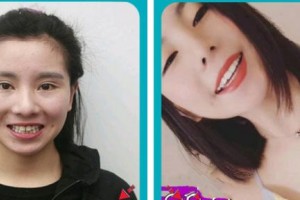 浙江大學(xué)醫(yī)學(xué)院附屬口腔醫(yī)院李志勇整形價(jià)格表附美白貼片案例展示