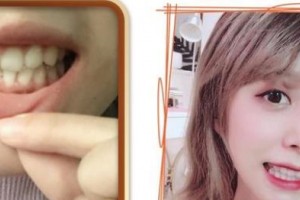 浙江大學(xué)醫(yī)學(xué)院附屬口腔醫(yī)院陳學(xué)鵬整形價(jià)格表附牙齒隱形矯正案例展示