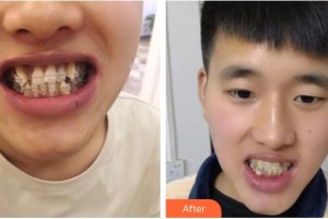 浙江大學(xué)醫(yī)學(xué)院附屬口腔醫(yī)院楊國利整形價(jià)格表附隱形托槽矯正案例展示