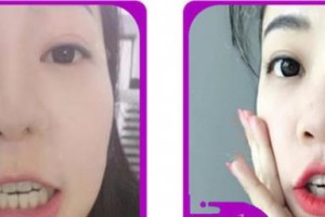 浙江大學(xué)醫(yī)學(xué)院附屬口腔醫(yī)院何建芳整形價(jià)格表附牙齒隱形矯正案例展示