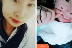 浙江大學(xué)醫(yī)學(xué)院附屬口腔醫(yī)院趙鵑整形價(jià)格表附牙綜合案例展示