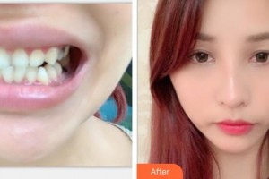 浙江大學(xué)醫(yī)學(xué)院附屬口腔醫(yī)院陳瑤整形價(jià)格表附牙齒隱形矯正案例展示