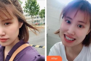 浙江大學(xué)醫(yī)學(xué)院附屬口腔醫(yī)院李文整形價(jià)格表附金屬托槽矯正案例展示