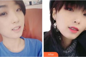 浙江大學(xué)醫(yī)學(xué)院附屬口腔醫(yī)院陳卓整形價(jià)格表附金屬托槽矯正案例展示