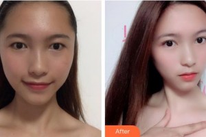 浙江省眼科醫(yī)院王勤美整形價(jià)格表附眼部綜合案例展示