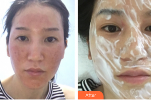 廣州海峽醫(yī)學整形美容醫(yī)院周紅英整形價格表附點陣激光祛痘印案例展示