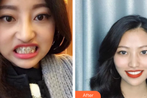 廣州圣貝口腔門診部趙艷明整形價格表附牙齒矯正案例展示