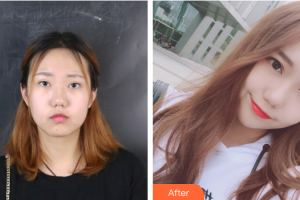 廣州醫(yī)科大學附屬第一醫(yī)院整形外科王肅生整形價格表附創(chuàng)可貼面部吸脂案例展示