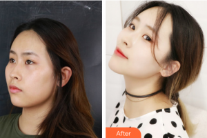 廣州博仕整形美容醫(yī)院李帥敏整形價格表附創(chuàng)可貼面部吸脂瘦臉術案例展示