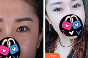 廣州圣諾達醫(yī)療美容門診部周豐整形價格表附重臉術修復案例展示