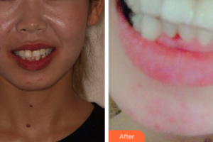 廣州圣貝口腔門診部張婉瑜整形價格表附牙齒隱形矯正案例展示