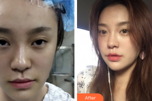 廣州圣諾達醫(yī)療美容門診部吳偉航整形價格表附埋線提升案例展示