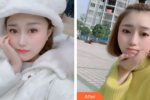 廣州穗華口腔醫(yī)院馮智強整形價格表附牙齒金屬矯正案例展示