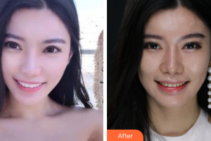 廣州穗華口腔醫(yī)院賴仁發(fā)整形價格表附瓷貼面案例展示