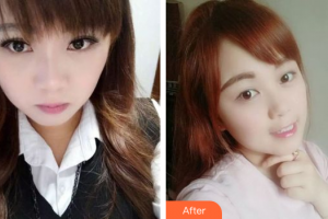 廣州穗華口腔醫(yī)院劉志昕整形價格表附牙齒隱形矯正案例展示