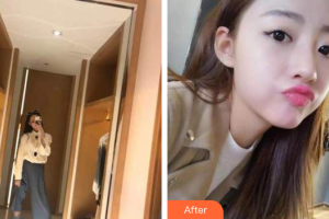 廣州穗華口腔醫(yī)院張武整形價格表附時代天使矯正案例展示