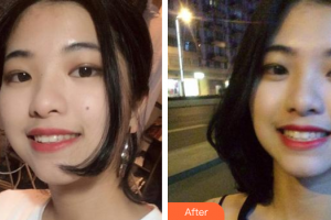 廣州穗華口腔醫(yī)院聶謝超整形價格表附隱形牙齒矯正案例展示