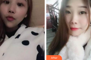 廣州穗華口腔醫(yī)院許輝紅整形價格表附自鎖托槽矯正案例展示