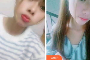 廣州穗華口腔醫(yī)院夏麗梅整形價格表附牙齒根管調(diào)節(jié)案例展示