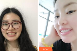 廣州穗華口腔醫(yī)院李奇?zhèn)フ蝺r(jià)格表附牙齒金屬矯正案例展示