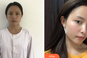 廣州深美醫(yī)療美容門(mén)診部鄧海清整形價(jià)格表附面部吸脂案例展示