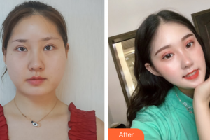 廣州姬妍醫(yī)療美容門(mén)診部何瑤整形價(jià)格表附面部吸脂案例展示