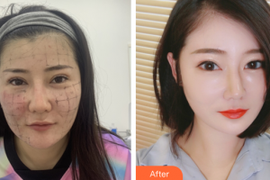 廣州深美醫(yī)療美容門(mén)診部曾立整形價(jià)格表附熱瑪吉案例展示