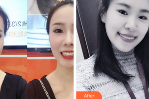 廣州暨博口腔醫(yī)院鐘梅整形價(jià)格表附牙齒隱形矯正案例展示