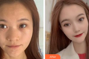 廣州姬妍醫(yī)療美容門(mén)診部龔湛整形價(jià)格表附鼻部手術(shù)案例展示