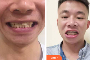 廣州健業(yè)口腔醫(yī)院黃華整形價(jià)格表附隱形牙齒矯正案例展示