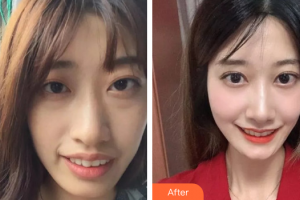 廣州瑞德口腔醫(yī)院汪贏整形價(jià)格表附牙齒矯正案例展示