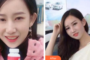 廣州健業(yè)口腔醫(yī)院翁文利整形價(jià)格表附牙齒隱形矯正案例展示