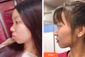 廣州愛(ài)康健口腔門(mén)診部周小明整形價(jià)格表附金屬托槽矯正案例展示