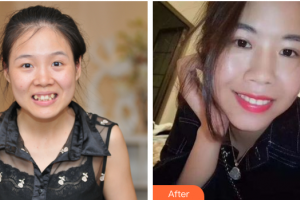 廣州愛(ài)康健口腔門(mén)診部楊巍華整形價(jià)格表附金屬托槽矯正案例展示