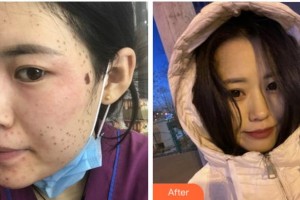 杭州時(shí)光醫(yī)療美容醫(yī)院劉耿整形價(jià)格表附激光美膚激光案例展示