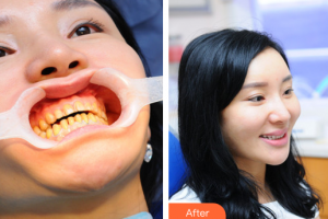 廣州愛康健口腔門診部楊福強整形價格表附美白貼片案例展示