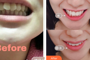 廣州愛(ài)康健口腔門(mén)診部李格整形價(jià)格表附隱形矯正案例展示