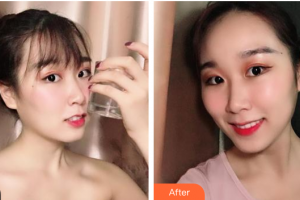 廣州愛(ài)康健口腔門(mén)診部馮曉瑛整形價(jià)格表附牙齒隱形矯正案例展示