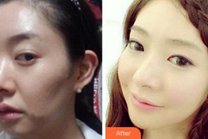 杭州新友好整形醫(yī)院袁利森整形價(jià)格表附埋線提升案例展示