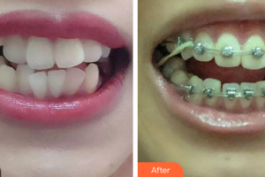 廣州市荔灣區(qū)口腔醫(yī)院程露整形價(jià)格表附金屬托槽矯正案例展示